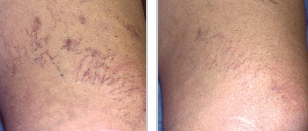 Sclerotherapy in Beavercreek | PureMD